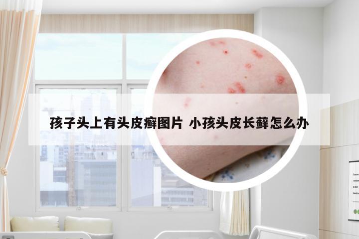 孩子头上有头皮癣图片 小孩头皮长藓怎么办