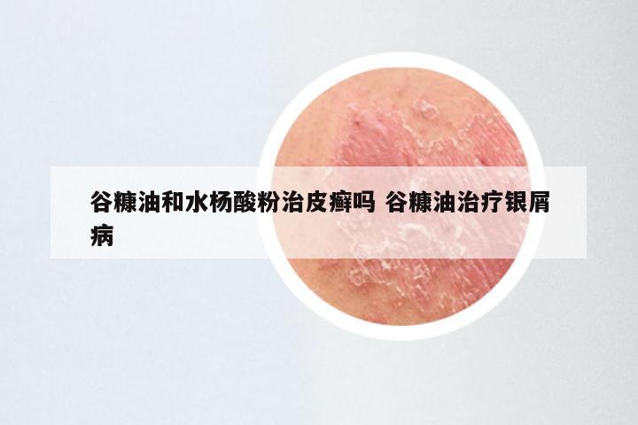 谷糠油和水杨酸粉治皮癣吗 谷糠油治疗银屑病