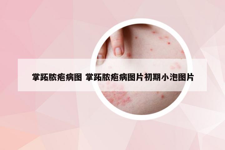 掌跖脓疱病图 掌跖脓疱病图片初期小泡图片