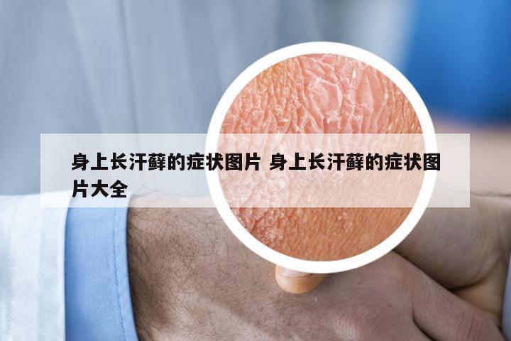 身上长汗藓的症状图片 身上长汗藓的症状图片大全