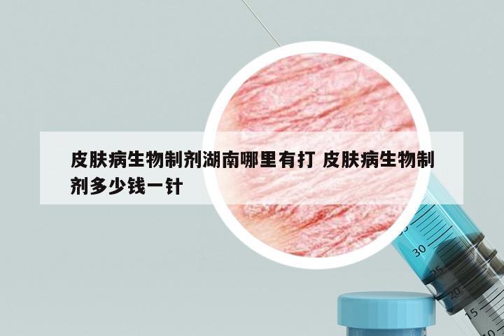 皮肤病生物制剂湖南哪里有打 皮肤病生物制剂多少钱一针