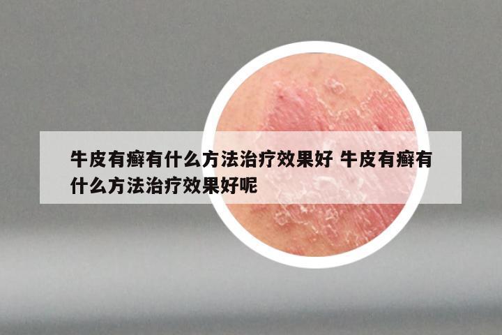 牛皮有癣有什么方法治疗效果好 牛皮有癣有什么方法治疗效果好呢