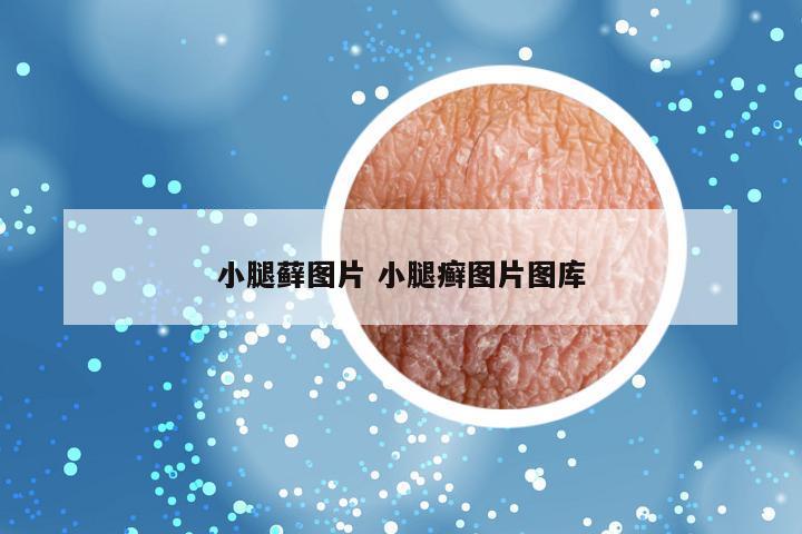 小腿藓图片 小腿癣图片图库