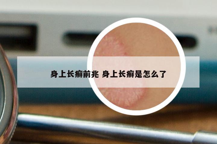 身上长癣前兆 身上长癣是怎么了