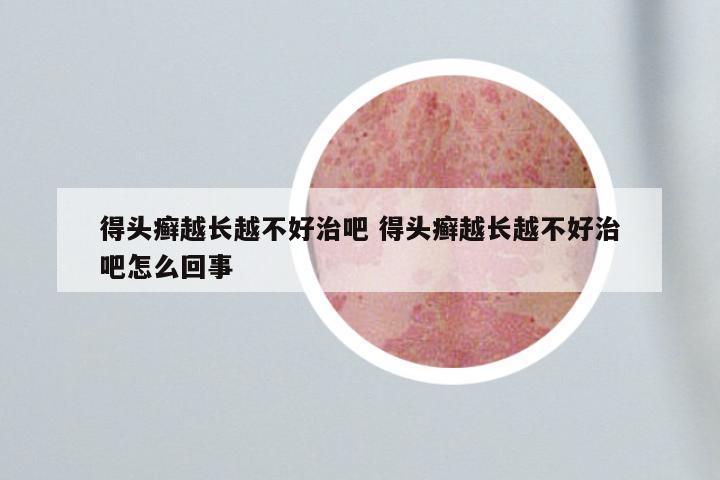 得头癣越长越不好治吧 得头癣越长越不好治吧怎么回事