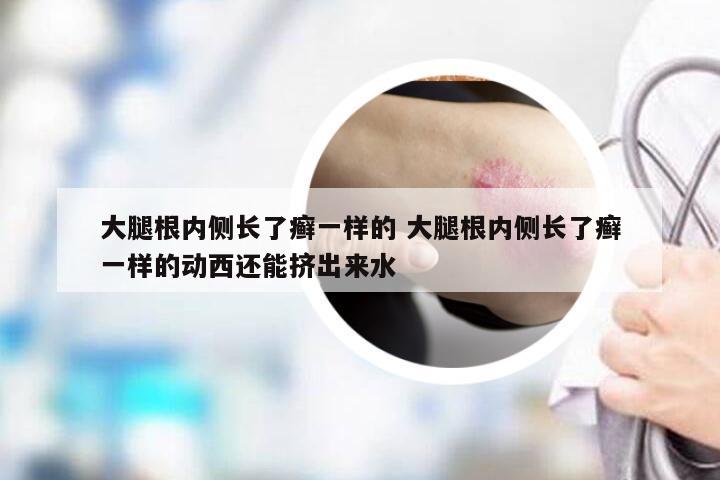 大腿根内侧长了癣一样的 大腿根内侧长了癣一样的动西还能挤出来水