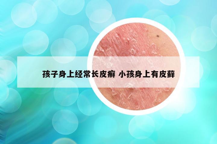 孩子身上经常长皮癣 小孩身上有皮藓