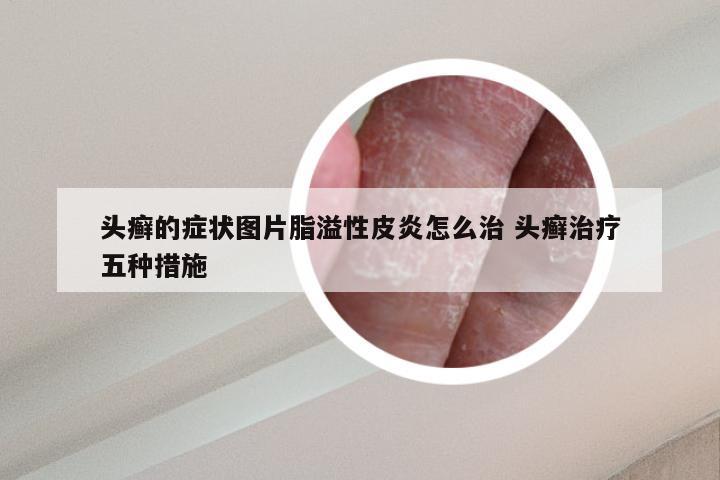 头癣的症状图片脂溢性皮炎怎么治 头癣治疗五种措施