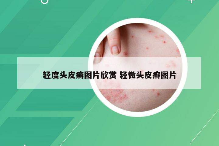 轻度头皮癣图片欣赏 轻微头皮癣图片