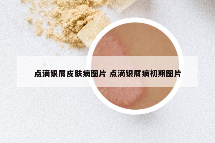 点滴银屑皮肤病图片 点滴银屑病初期图片