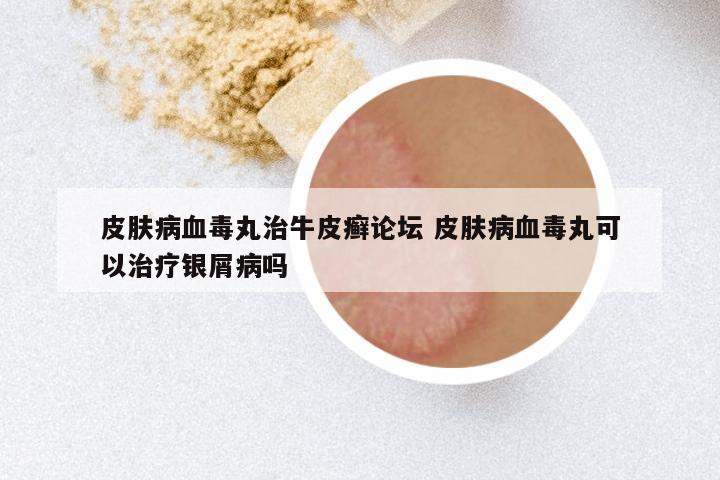 皮肤病血毒丸治牛皮癣论坛 皮肤病血毒丸可以治疗银屑病吗