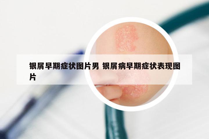 银屑早期症状图片男 银屑病早期症状表现图片