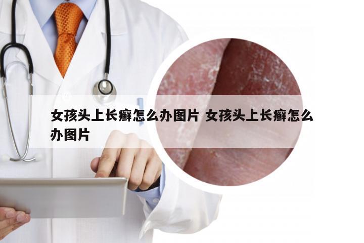 女孩头上长癣怎么办图片 女孩头上长癣怎么办图片
