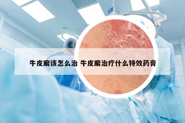 牛皮廨该怎么治 牛皮廨治疗什么特效药膏
