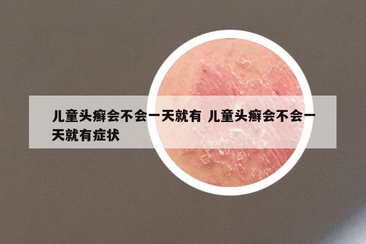 儿童头癣会不会一天就有 儿童头癣会不会一天就有症状