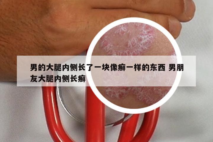 男的大腿内侧长了一块像癣一样的东西 男朋友大腿内侧长癣