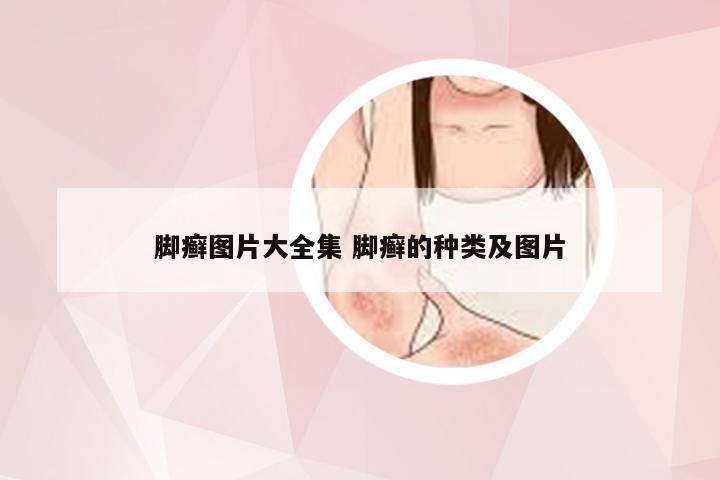 脚癣图片大全集 脚癣的种类及图片
