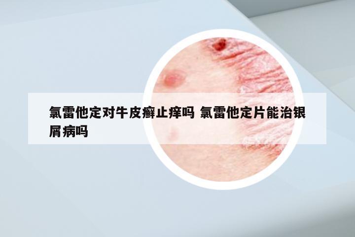 氯雷他定对牛皮癣止痒吗 氯雷他定片能治银屑病吗
