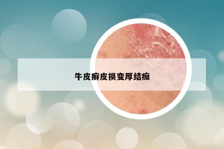 牛皮癣皮损变厚结痂
