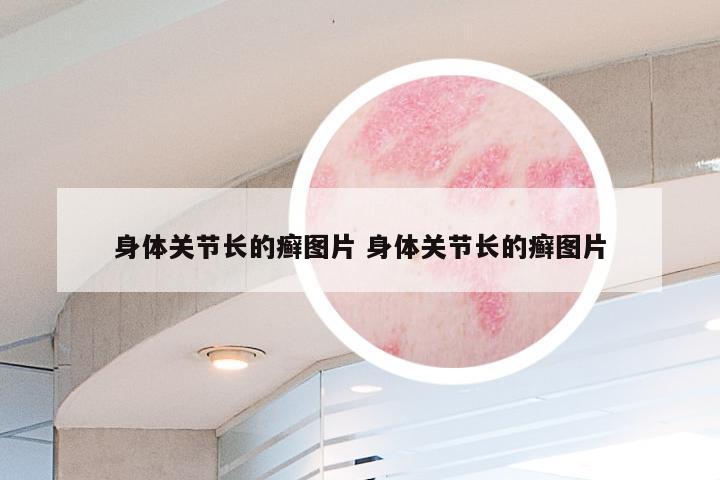 身体关节长的癣图片 身体关节长的癣图片