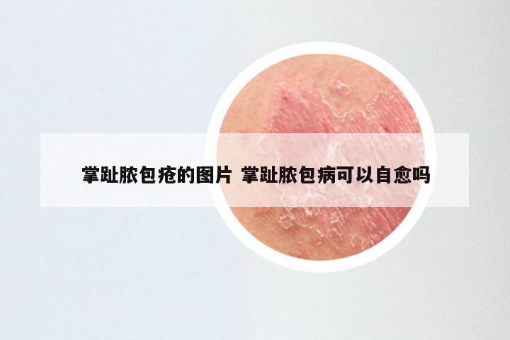 掌趾脓包疮的图片 掌趾脓包病可以自愈吗