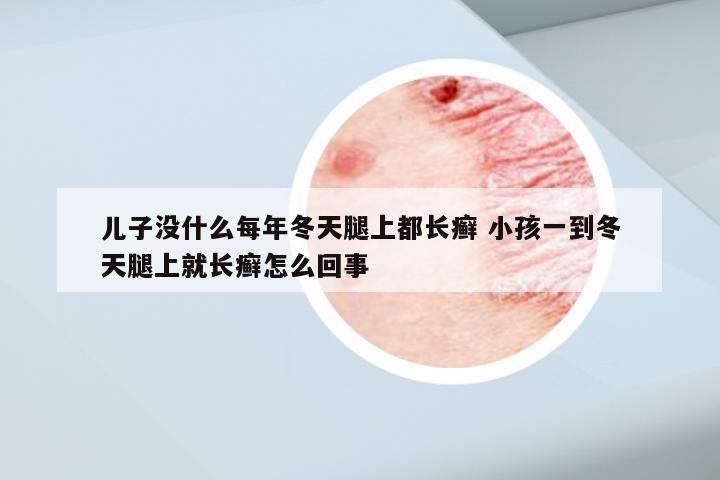 儿子没什么每年冬天腿上都长癣 小孩一到冬天腿上就长癣怎么回事