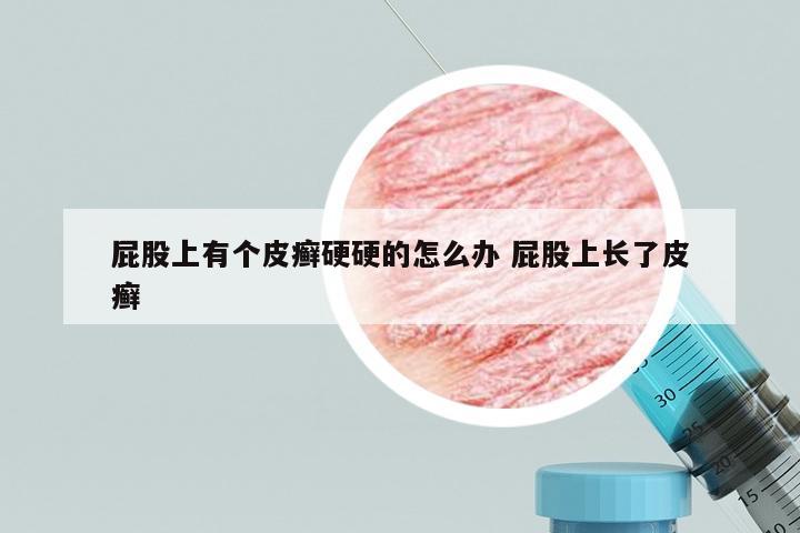 屁股上有个皮癣硬硬的怎么办 屁股上长了皮癣