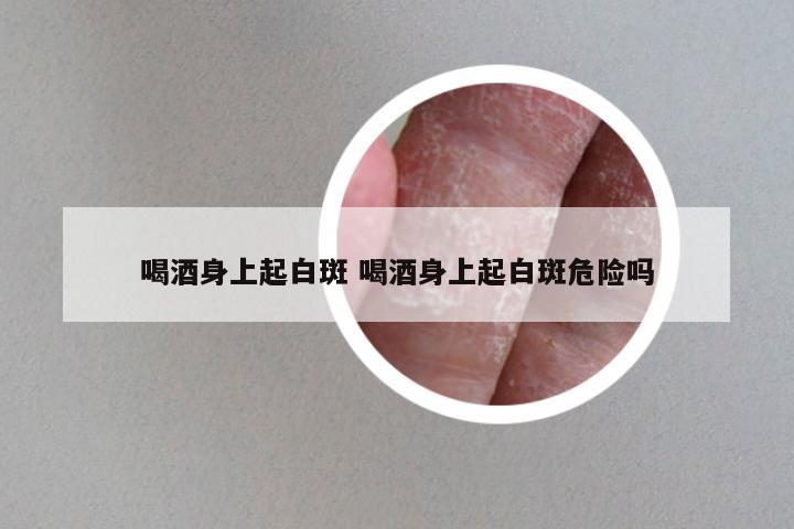 喝酒身上起白斑 喝酒身上起白斑危险吗