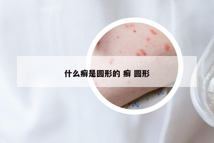 什么癣是圆形的 癣 圆形