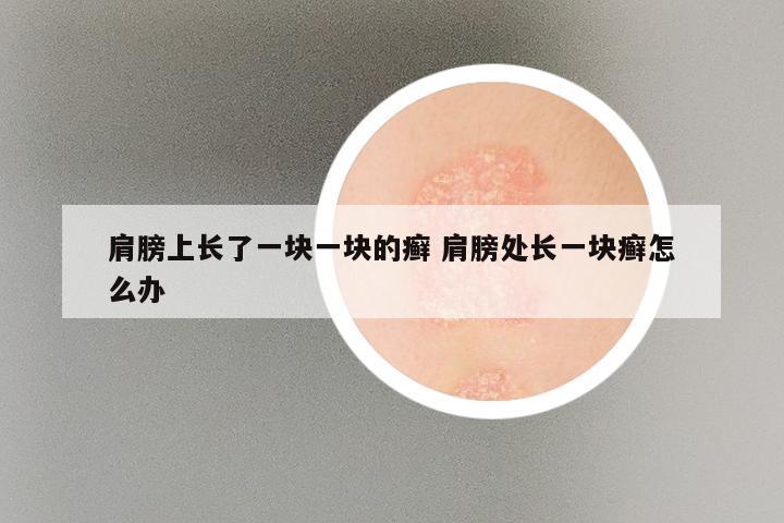 肩膀上长了一块一块的癣 肩膀处长一块癣怎么办