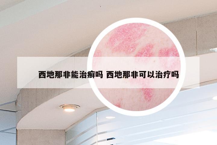 西地那非能治癣吗 西地那非可以治疗吗
