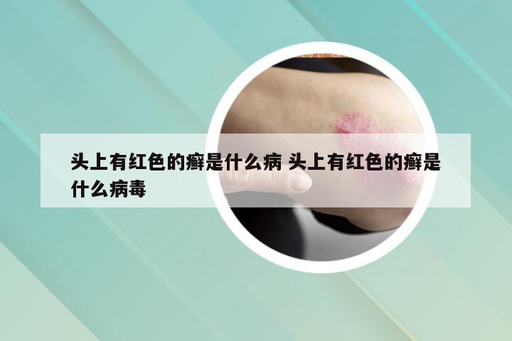 头上有红色的癣是什么病 头上有红色的癣是什么病毒