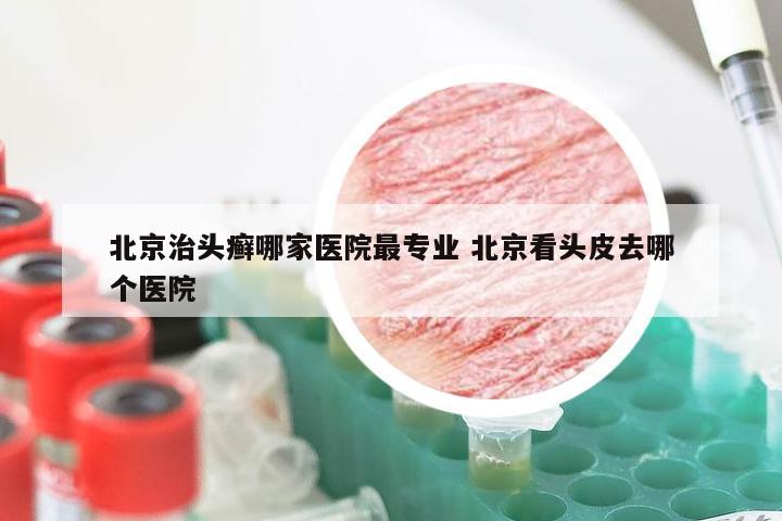 北京治头癣哪家医院最专业 北京看头皮去哪个医院