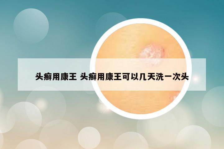 头癣用康王 头癣用康王可以几天洗一次头