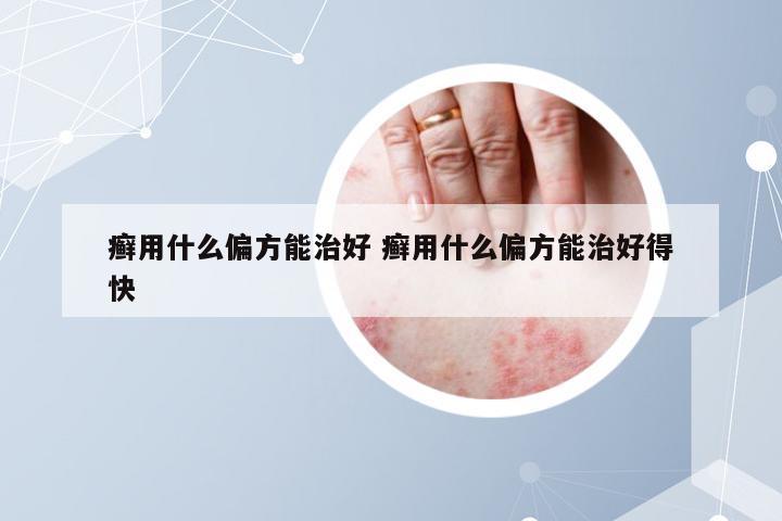 癣用什么偏方能治好 癣用什么偏方能治好得快