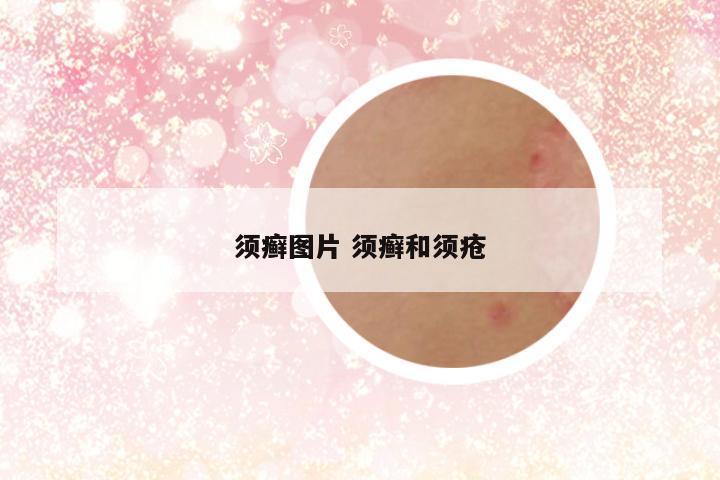 须癣图片 须癣和须疮