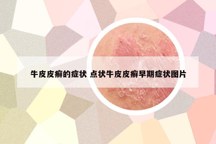 牛皮皮癣的症状 点状牛皮皮癣早期症状图片