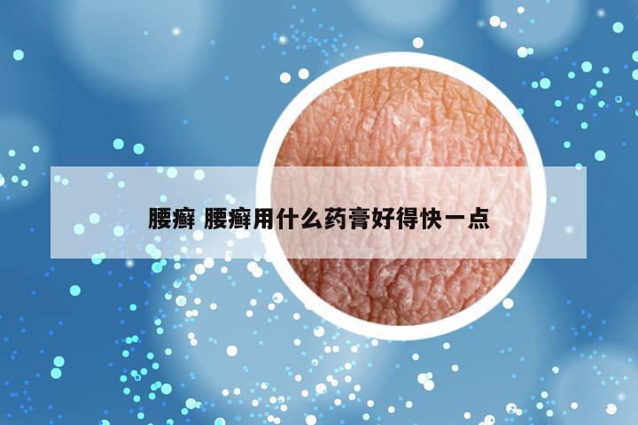 腰癣 腰癣用什么药膏好得快一点