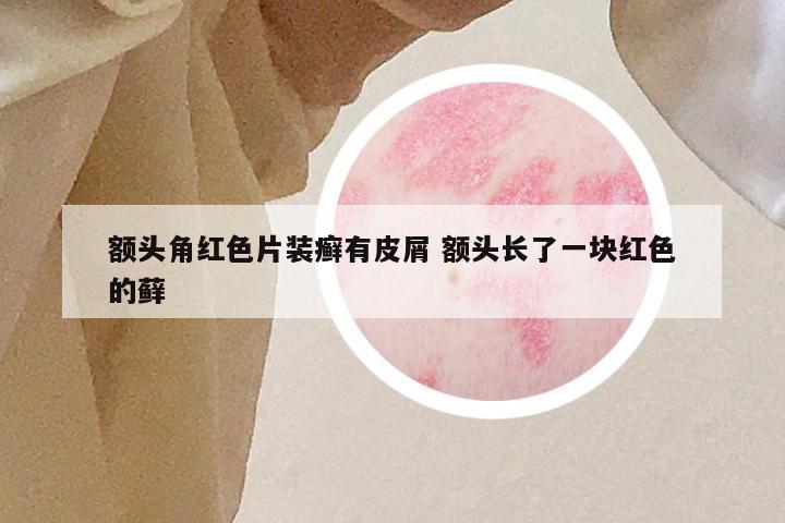 额头角红色片装癣有皮屑 额头长了一块红色的藓