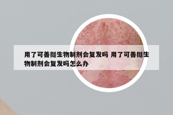 用了可善挺生物制剂会复发吗 用了可善挺生物制剂会复发吗怎么办