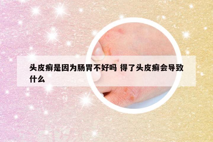 头皮癣是因为肠胃不好吗 得了头皮癣会导致什么