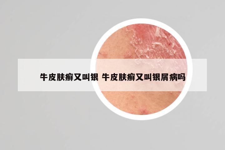 牛皮肤癣又叫银 牛皮肤癣又叫银屑病吗
