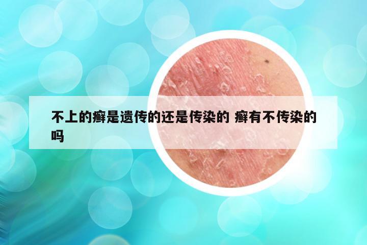 不上的癣是遗传的还是传染的 癣有不传染的吗