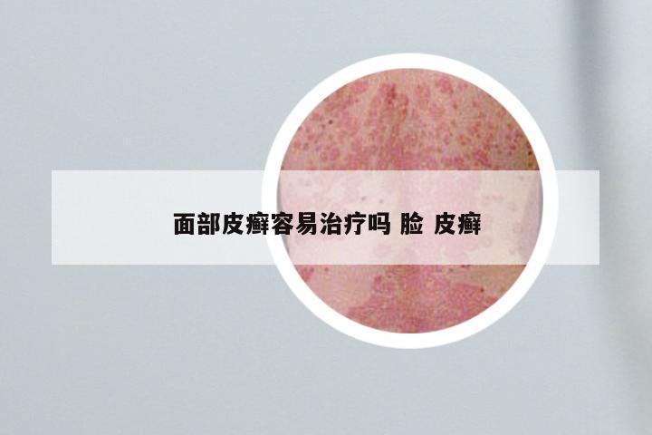 面部皮癣容易治疗吗 脸 皮癣