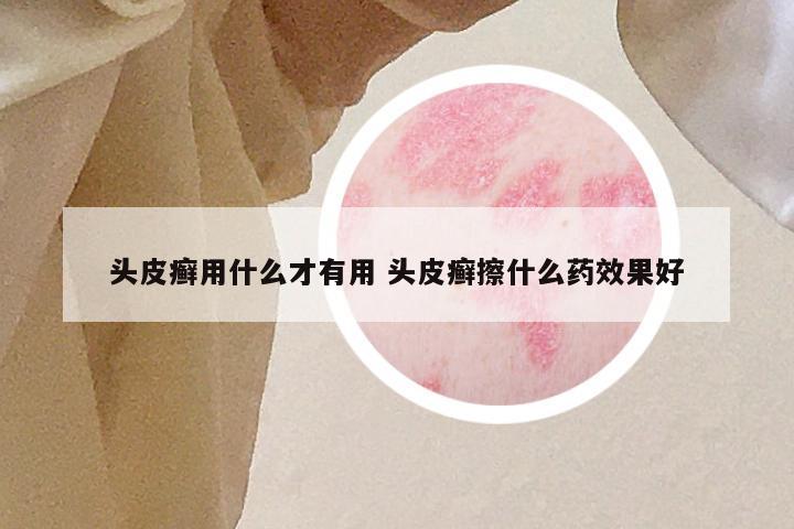 头皮癣用什么才有用 头皮癣擦什么药效果好