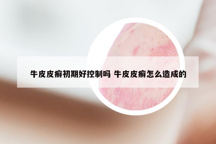 牛皮皮癣初期好控制吗 牛皮皮癣怎么造成的