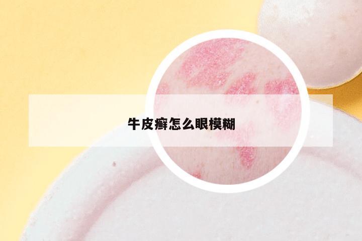 牛皮癣怎么眼模糊