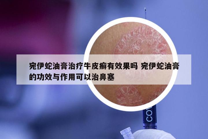 宛伊蛇油膏治疗牛皮癣有效果吗 宛伊蛇油膏的功效与作用可以治鼻塞