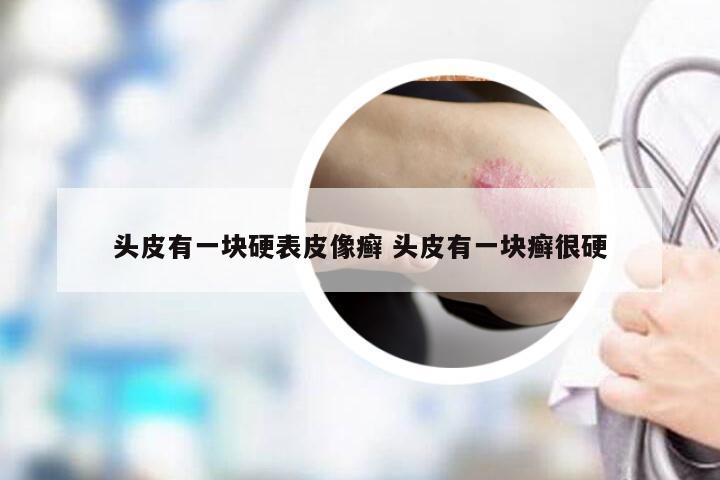 头皮有一块硬表皮像癣 头皮有一块癣很硬