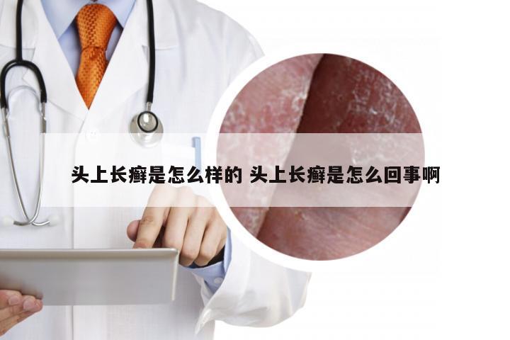 头上长癣是怎么样的 头上长癣是怎么回事啊